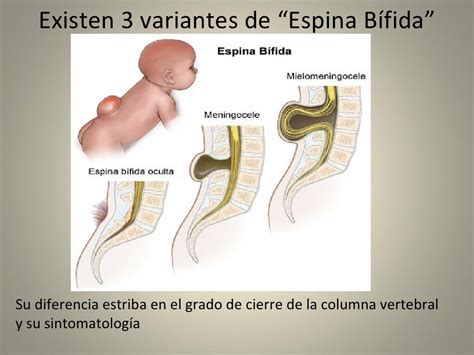 espina bifida que es